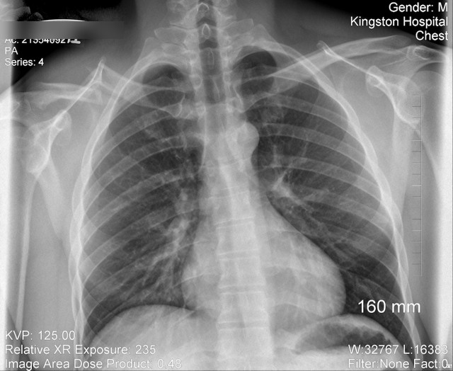X-ray of a bone injury — the type of acute injury San Huang San addresses